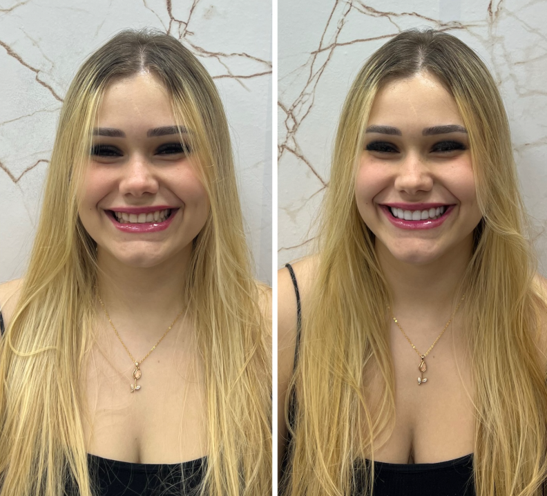 Antes e Depois - Transformação 4